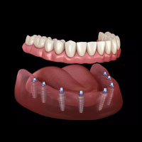 All on 8 Dental Implants