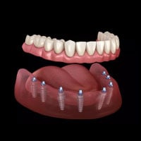 All on 8 dental implants in Turkey