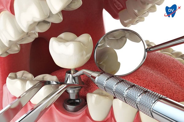 Implant Placement