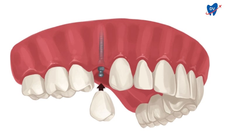 Mini Implant in Romania