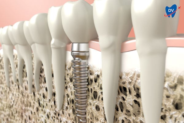 Osseointegration