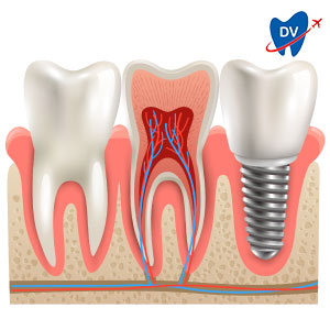 Risks with Dental Implant
