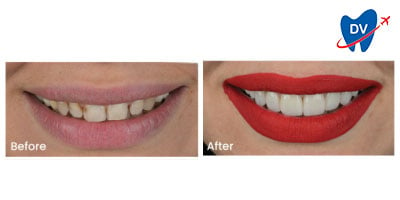 Veneers in Turkey | Before and After