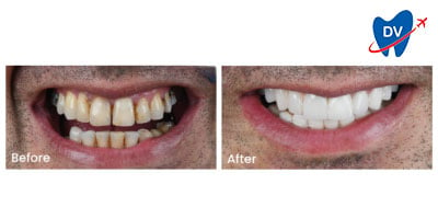 Dental Veneers in Turkey: Before & After