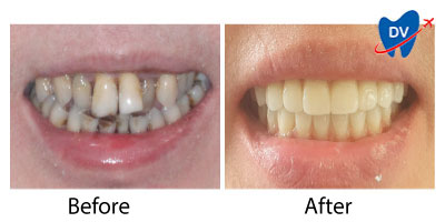 Bucharest Dental Implants Before & After