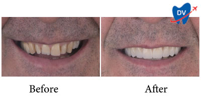 Before and After Dental Veneers in Zagreb, Croatia