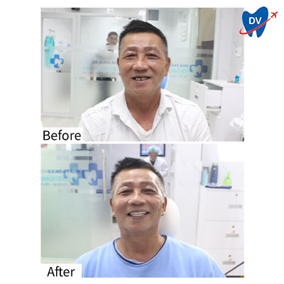 Dental Implants in Vietnam (Before & After)