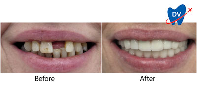 Dental Implants Kusadasi Before & After