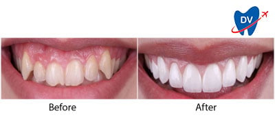 Emax Crowns in Kusadasi | Before & After