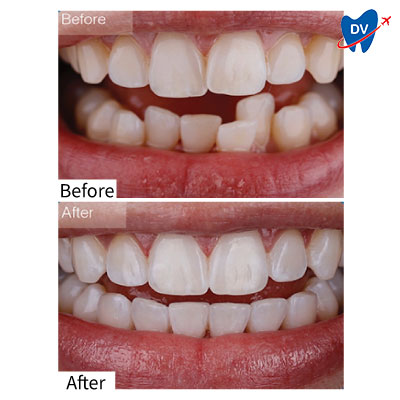 Invisalign Treatment in Vietnam (Before & After)