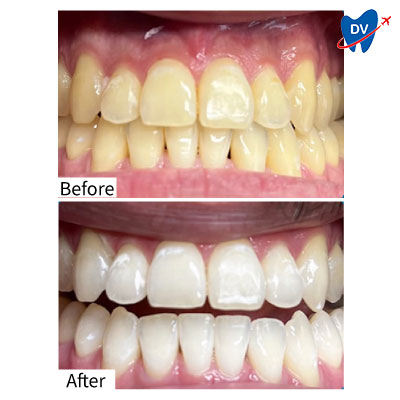 Teeth Whitening in Vietnam (Before & After)