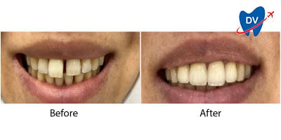 Zirconium Crowns in Kusadasi | Before & After