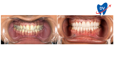 Dental Veneers in Mexico: Before & After