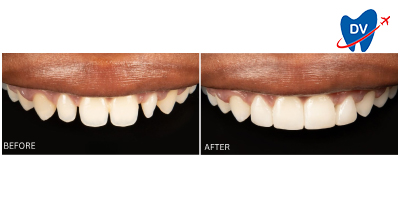 Dental Veneers in Tijuana: Before & After