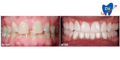 Dental Veneers Mexico: Before & After