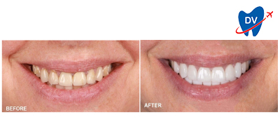 Dental Veneers Tijuana: Before & After