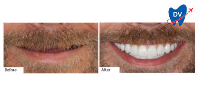 Full Mouth Restoration Los Algodones | Before & After
