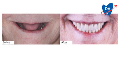 Full Mouth Restoration Los Algodones | Before & After