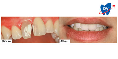 Dental crowns in Portugal - Before & After