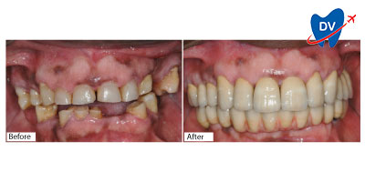 Full Mouth Restoration in Portugal | Before & After