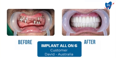 All on 4 dental implants in Ho Chi Minh City