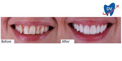Smile transformation with Istanbul Hollywood Smile