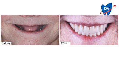 Carol's Smile Transformation With All on 4 Dental Implants in Los Algodones, Mexico