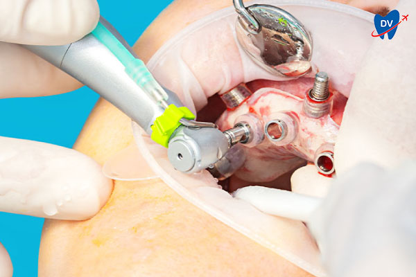 Dental Implant Surgery Using Surgical Guide