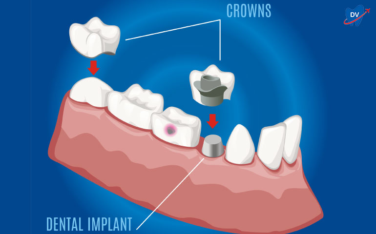 Dental Crown on an implant and damaged tooth 