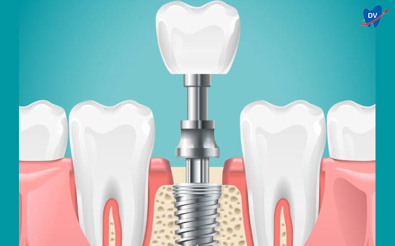 Typical Dental Implant Replacing the Natural Tooth Root