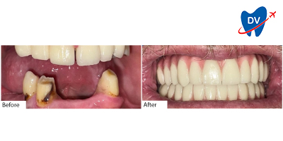 Before and After All on 4 Dental Implants Tijuana