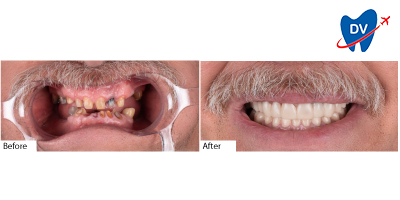 Before and After All on 4 Dental Implants Tijuana