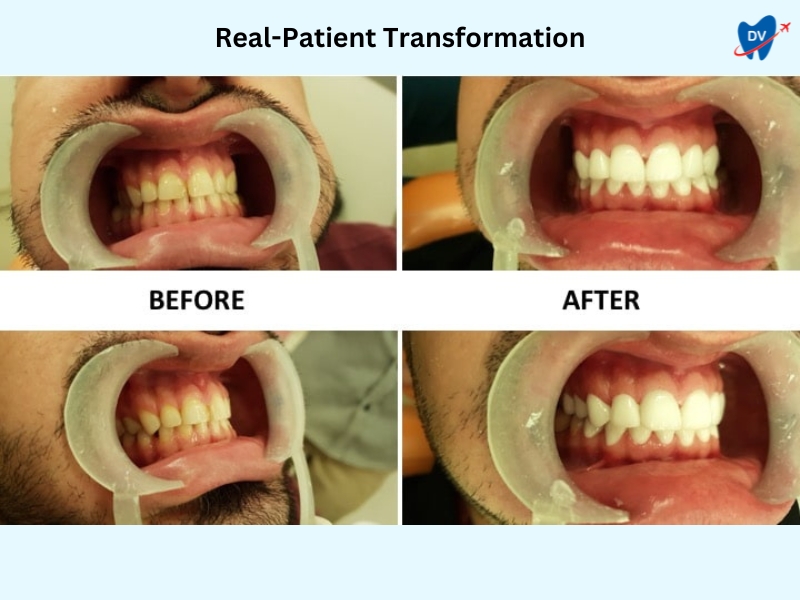 Dental Crowns in Bangalore, India: Before & After