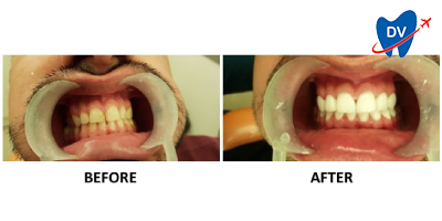 Dental Crowns in Bangalore, India | Before & After