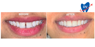 Dental Veneers in Bangalore, India | Before & After