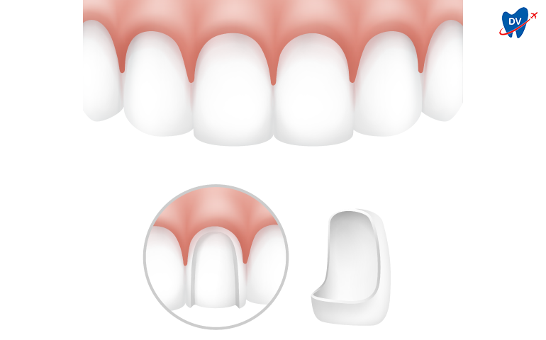 Dental Veneers Izmir Turkey