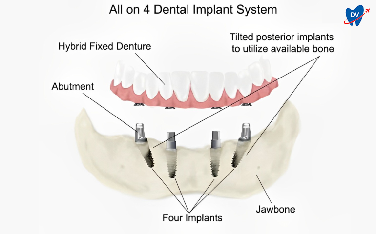All on 4 Dental Implants in Bodrum, Turkey