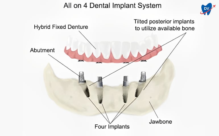 All on 4 Dental Implants