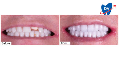Before and After Dental Implants in Mexico
