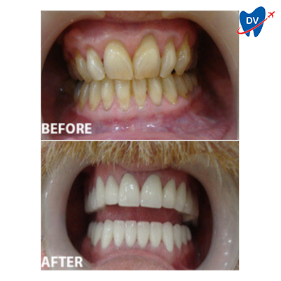 Before and After Dental Veneers | Ho Chi Minh City, Vietnam