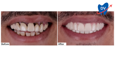 Before and after all on 4 implants in Istanbul, turkey