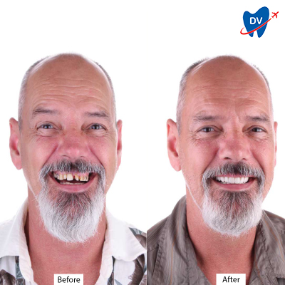 Before & After Dental Crowns in Cancun