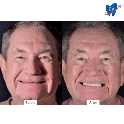 Before & After Dental Crowns in Cancun