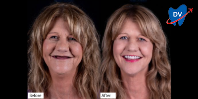 Full mouth dental implants with all on 4 in Nogales - Before & After