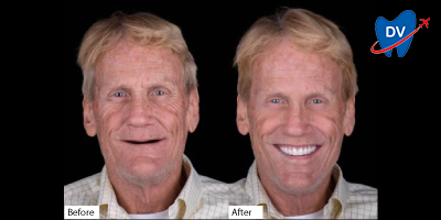 Full mouth dental implants with all on 4 in Nogales - Before & After