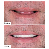 Before and After denture transformation in Turkey