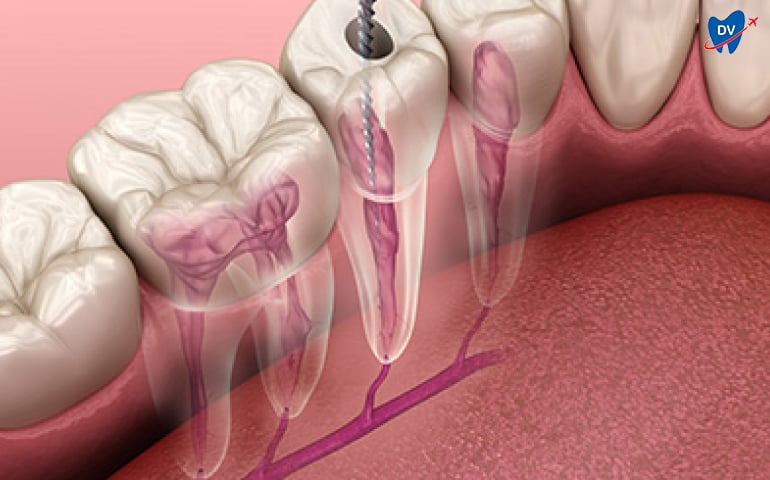 Root Canal Treatment