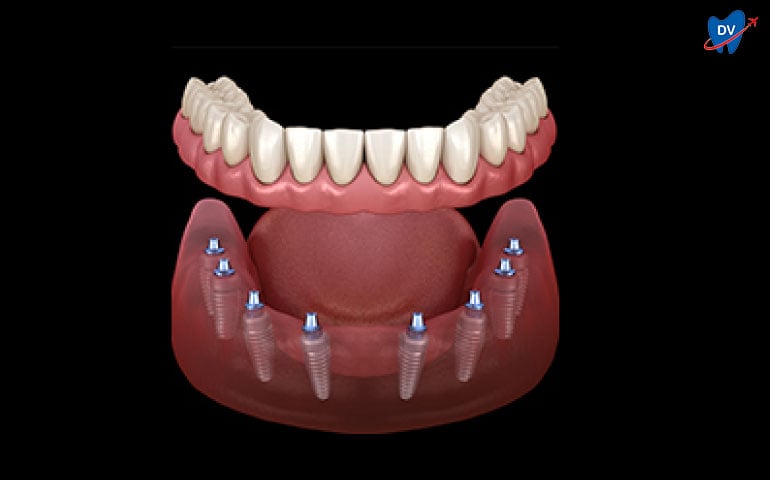 All on 8 Dental Implants in Indonesia