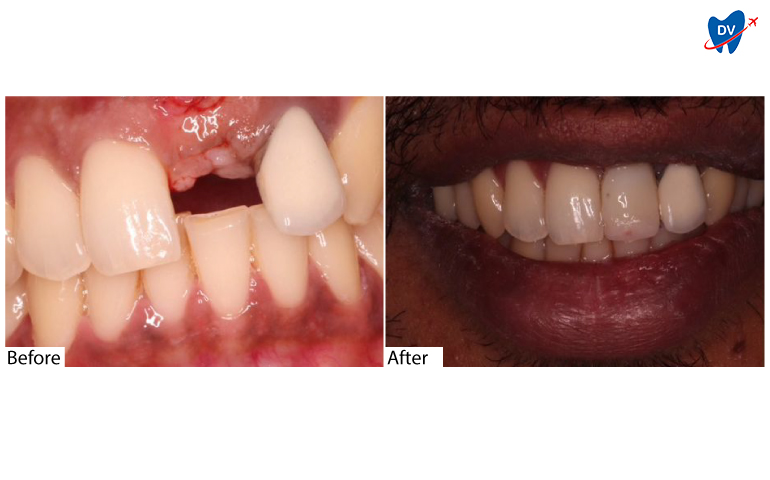 Dental Implants in Mangalore, India: Before & After