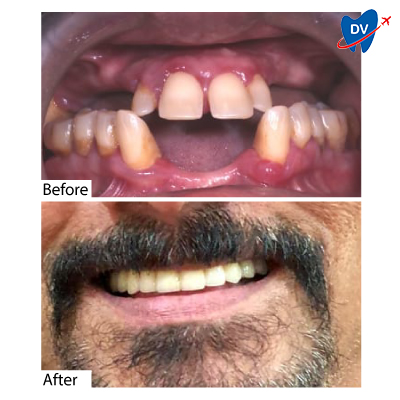 Dental Implants in Mangalore: Before & After